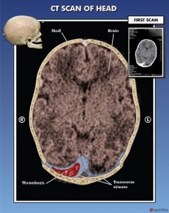 A brain scan showing a blood clot