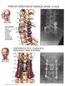 Pajcic Diagram of Cervical Spine