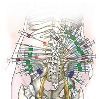 Injections diagram